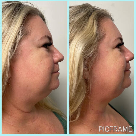 Before & After 1 treatment